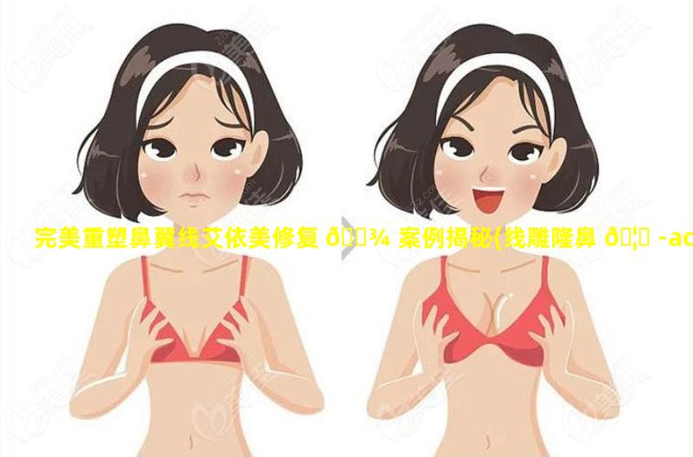 完美重塑鼻翼线艾依美修复 🌾 案例揭秘(线雕隆鼻 🦍 -acmetea艾苛蜜专用)